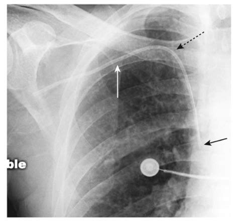 Chapter 10 Recognizing The Correct Placement Of Lines And Tubes And