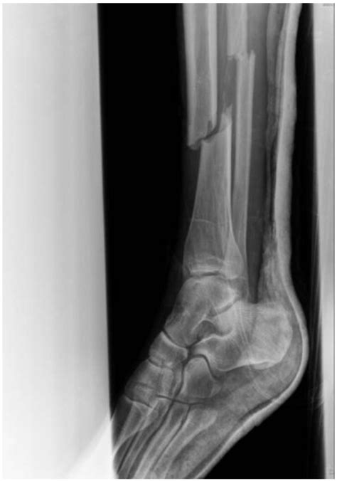 Fat Embolism Syndrome After Nailing An Isolated Open Tibial Fracture In