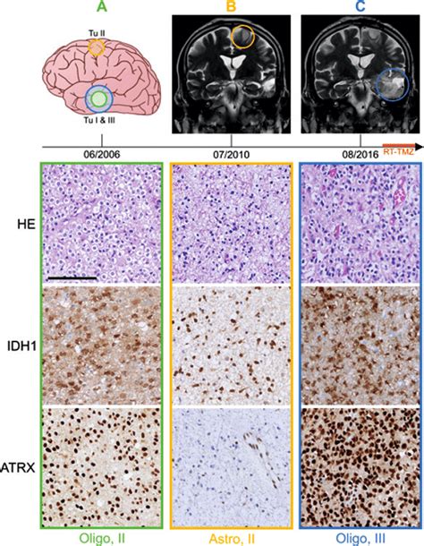 Spatiotemporal Evolution Of Temporal Oligodendroglioma And Frontal