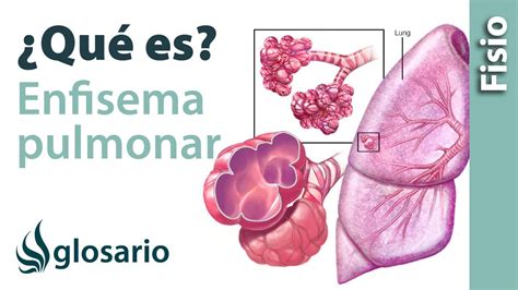 Enfisema Pulmonar Qué Es Qué Estructuras Afecta Síntomas Signos