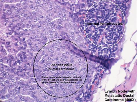 G – Lymph Node with Metastatic Ductal Carcinoma – 400X