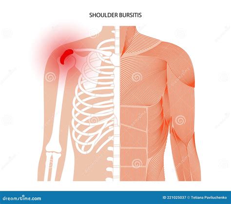 Concepto De Inflamaci N De Bursitis Ilustraci N Del Vector