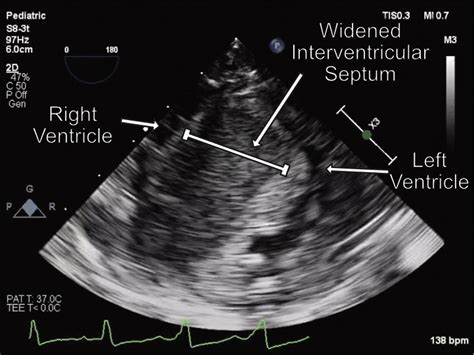 Interventricular Septal Hematoma Complicating Placement Of A