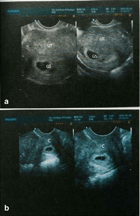 A Transvaginal Ultrasonography Showing A Gestational Sac In The Uterine