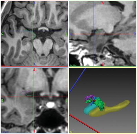 Visualisation of piriform cortex (PC) on the preoperative T1 MRI and in... | Download Scientific ...