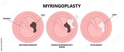 Perforated eardrum tube surgical drain Otitis media ear wax Hole repair ...