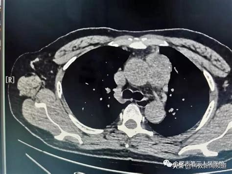 劍突下微創時代！合肥市三院成功實施胸腔鏡劍突下巨大胸腺瘤切除術 每日頭條