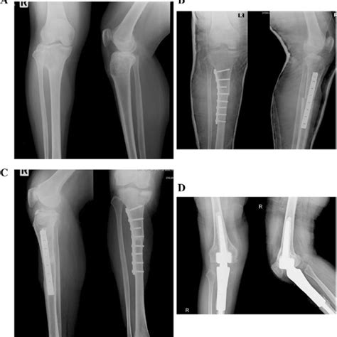 A Year Old Female With Osteosarcoma Of The Right Proximal Tibia A