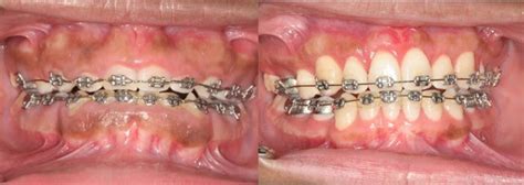 Swollen Gums With Braces