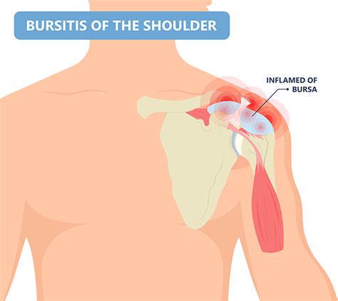 Subacromial Bursitis Dr Mohamed Attia M D PhD