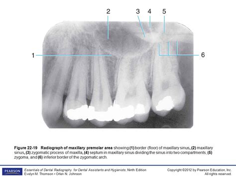 Floor Of Nasal Cavity Radiograph Viewfloor Co