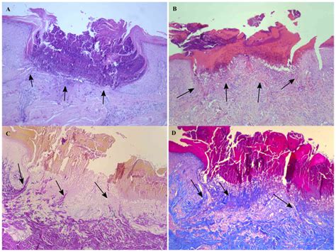 Clinical Characteristics And Prognosis Of Acquired Perforating