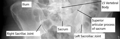 Normal Sacroiliac Joint X Ray