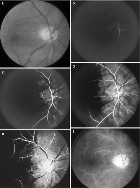 Ocular Ischemic Syndrome