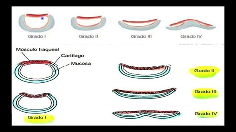 4 4 Colapso Traqueal YouTube