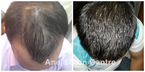 Fue Hair Transplant Fue Hair Transplant In Jalandhar Punjab India