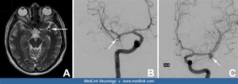 Unruptured Cerebral Aneurysms Medlink Neurology