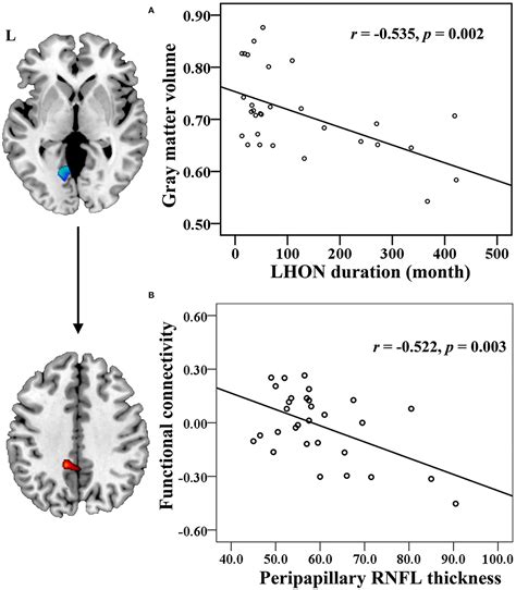 Frontiers Brain Gray Matter Atrophy And Functional Connectivity