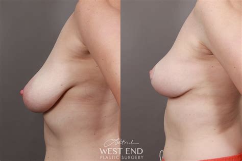 Breast Lift 4 Months Post Op Before After Gallery Case 10269