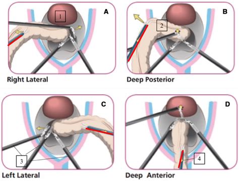 Recommended Robotic Set Up For Low Anterior Resection Bladder