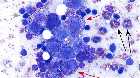 Image Gallery Lymph Node Cytology Clinician S Brief Hematología Histología