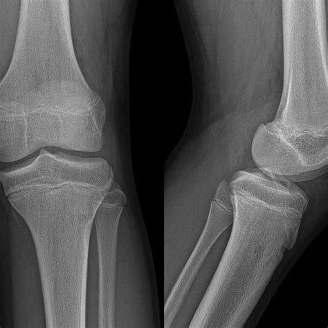 Anteroposterior And Lateral X Ray Views Of The Knee Of A 12 Year Old Download Scientific