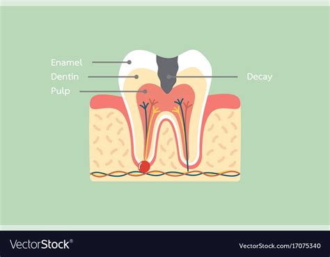 Tooth Decay Diagram