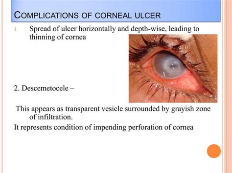 Bacterial Corneal Ulcer Drbp