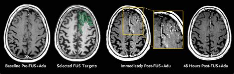 Ultrasound Bloodbrain Barrier Opening And Aducanumab In Alzheimers