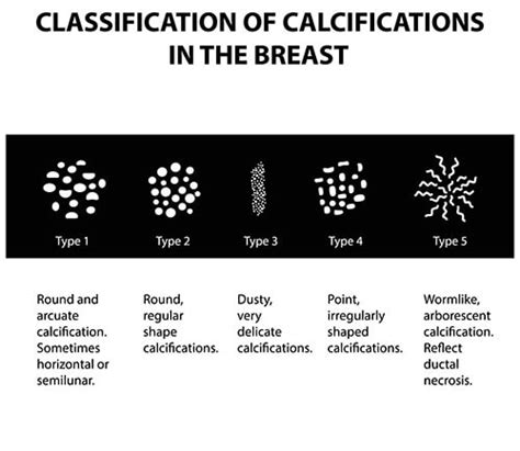 Breast Calcification On Mammograms May Reveal Common Hear