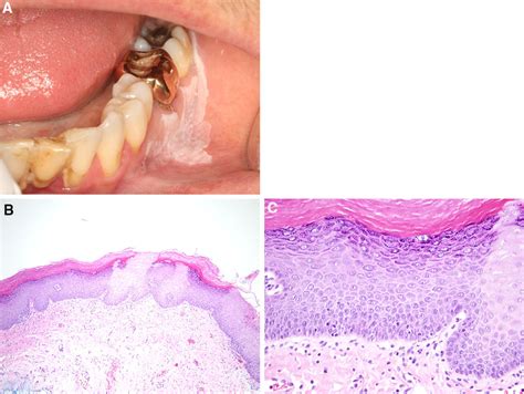 Hyperkeratosis Epithelial Atrophy And Chronic Inflammation Not