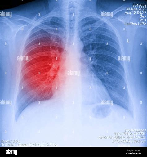 Radiografia Del Torace Mostra Un Paziente Immagini E Fotografie Stock