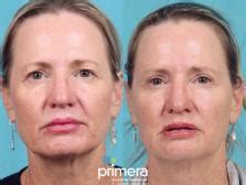 Endoscopic Forehead Lift Before And After Pictures Case Orlando