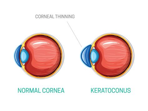 Keratoconus: symptoms, causes & treatment | Kraff Eye Institute