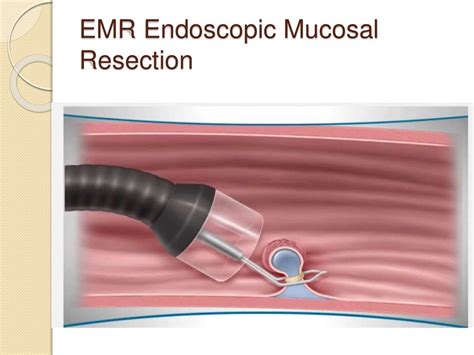 Treatment of Cancer of the Esophagus