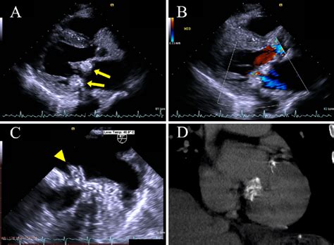 Figure2transthoracic Echocardiography With A Long Axis Parasternal Download Scientific Diagram