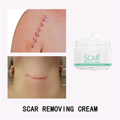 30ml Scar Removal Cream Acne Treatment Marks Pimples Surgical Repair Scars All Skin Face Body