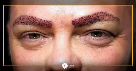 Lifting O Implante De Cejas Elige Correctamente Capilar Center