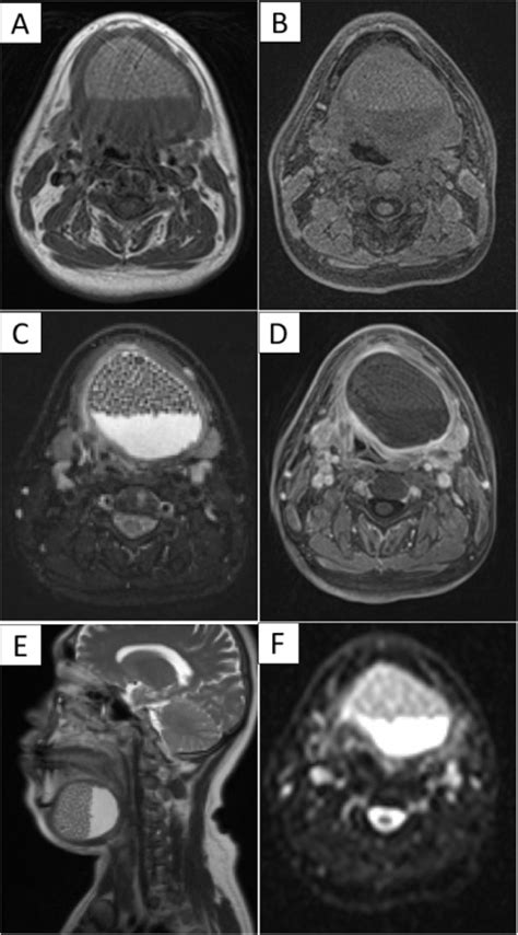 Dermoid Cyst Floor Of Mouth Radiology