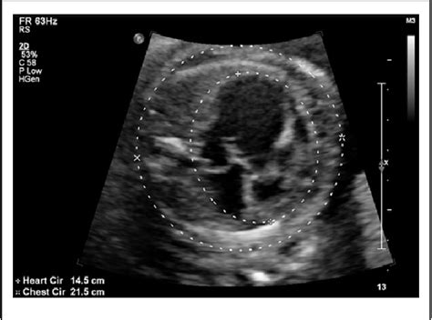 Figure 1 From Prenatal Sonographic Detection Of Ebsteins Anomaly