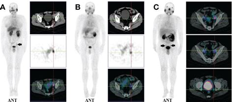 Frontiers Diagnostic Performance Of 99mTc HYNIC PSMA SPECT CT For