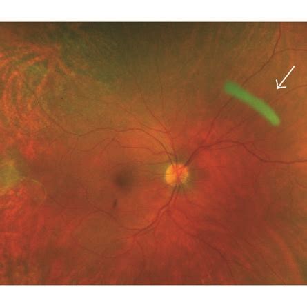 A Infrared Fundus Photo Of The Macula Showing Cystoid Macular Edema