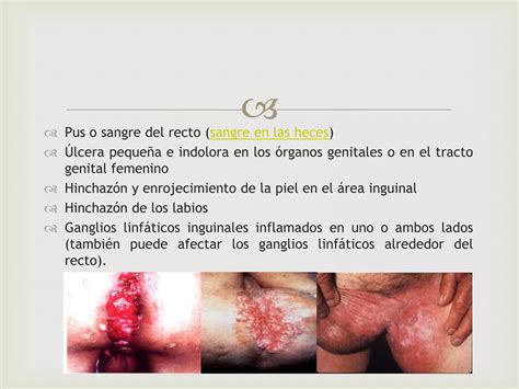 Linfogranuloma Venéreo Ppt