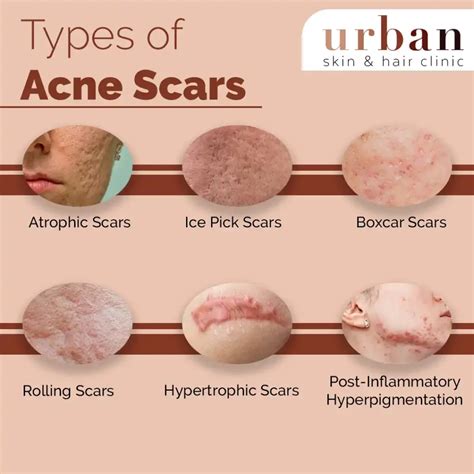 How to get rid of Acne Scars (Advice by Dermatologist )