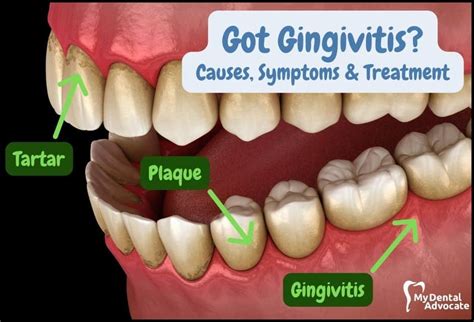 What Is Gingivitis Causes Symptoms And Treatment Mda