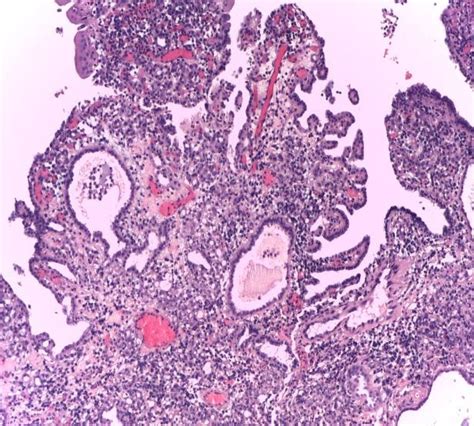 A And 1b Nephrogenic Adenoma Of The Urinary Bladder Hes X100 X200 Download Scientific Diagram