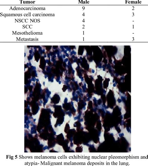 Correlation Between The Histological Tumor Type And Sex In Our Study