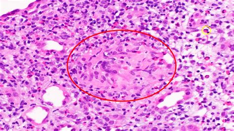 Pathology Outlines - Tubulointerstitial nephritis-general