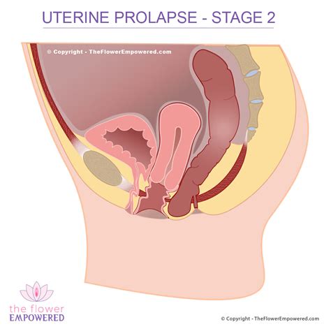 Uterine Prolapse Prolapsed Uterus Pelvic Organ Prolapse Stage 0 To 4