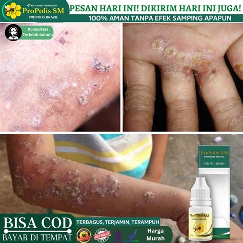 Jual Obat Budug Gatal Bernanah Obat Buduk Budukan Budugan Menahun